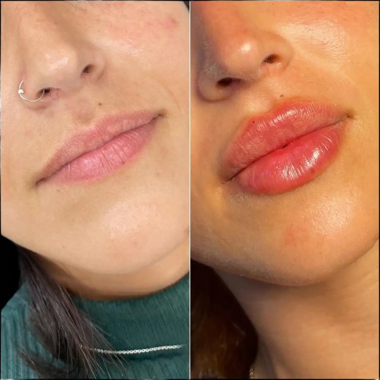 Why Choose the Best Doctors in Dubai for Lip Fillers?